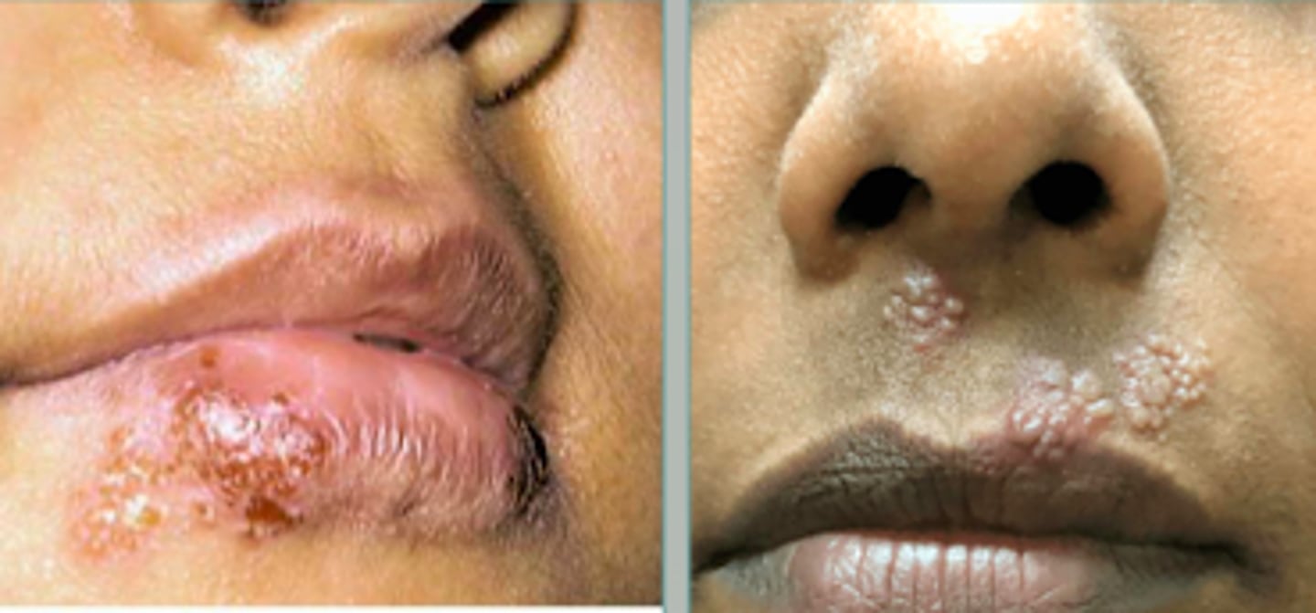 <p>Viral Skin Infections:</p><p>If a pt presented w the following S/S, what may we suspect they have:</p><p>- 2-20 day incubation</p><p>- often asymptomatic, but this patient has vesicles on their lip</p><p>- regional lymphadenopathy</p><p>- fever, headache, malaise, myalgia</p><p>- resolves in 3-4 days</p>