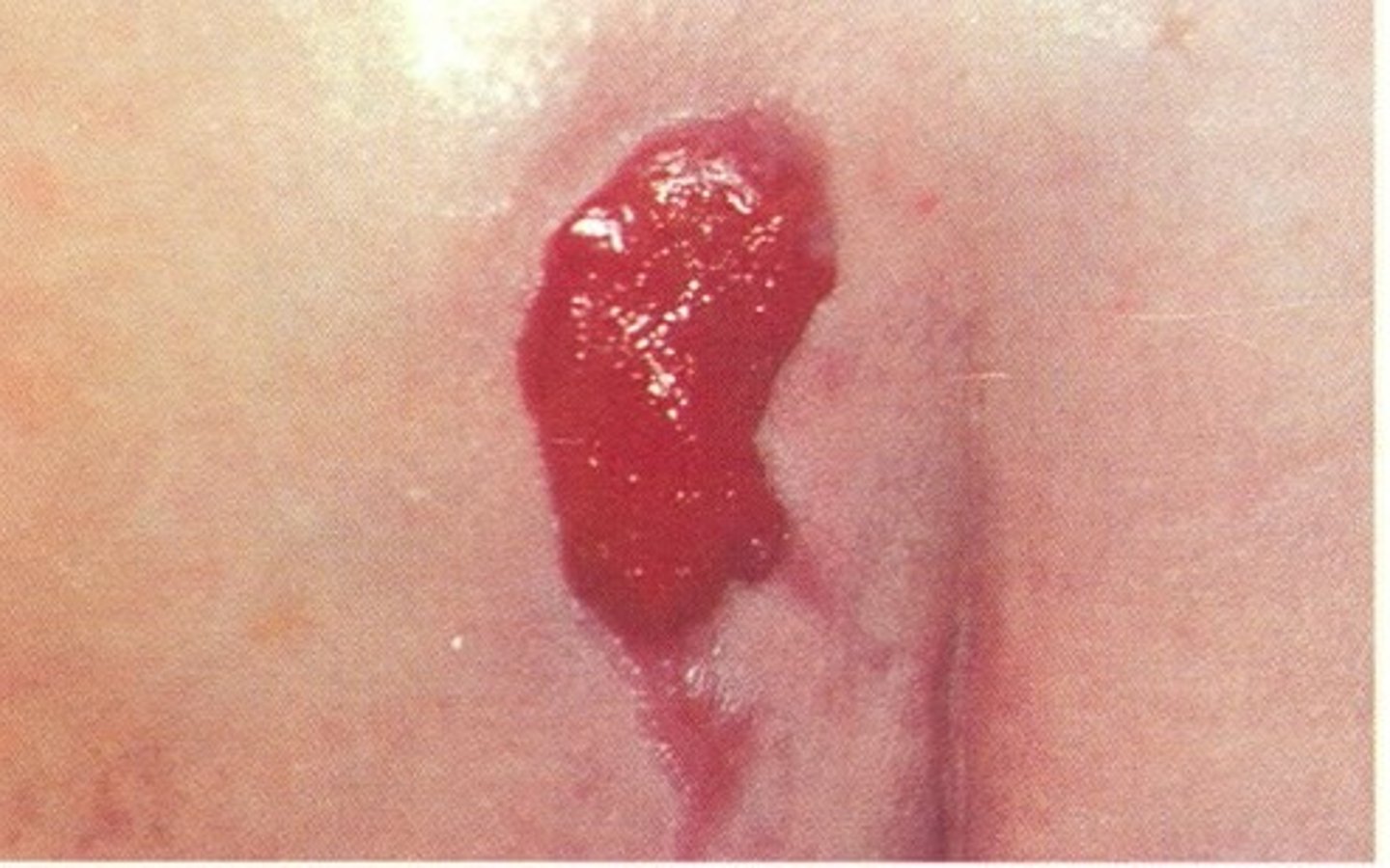 <p>The wound bed develops "beefy red" granulation tissue. You may see small endothelial buds (angiogenesis) and a pale pink border at the wound edges (epithelialization)</p>