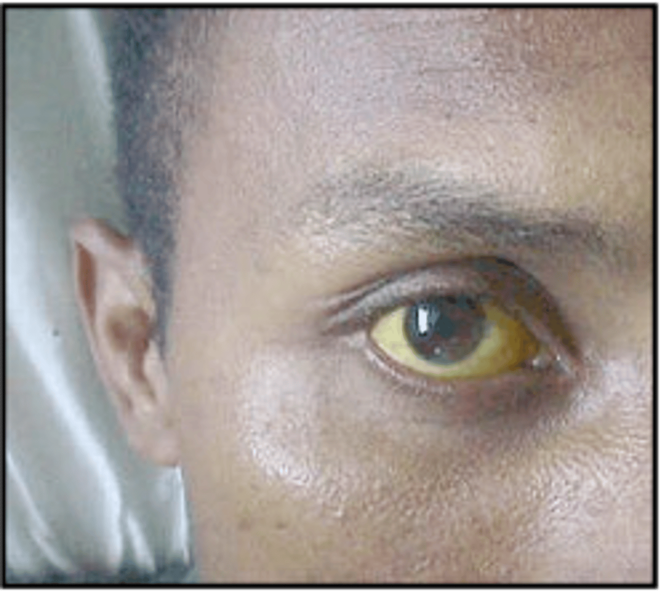 <p>a person presenting with this is likely infected with...</p>