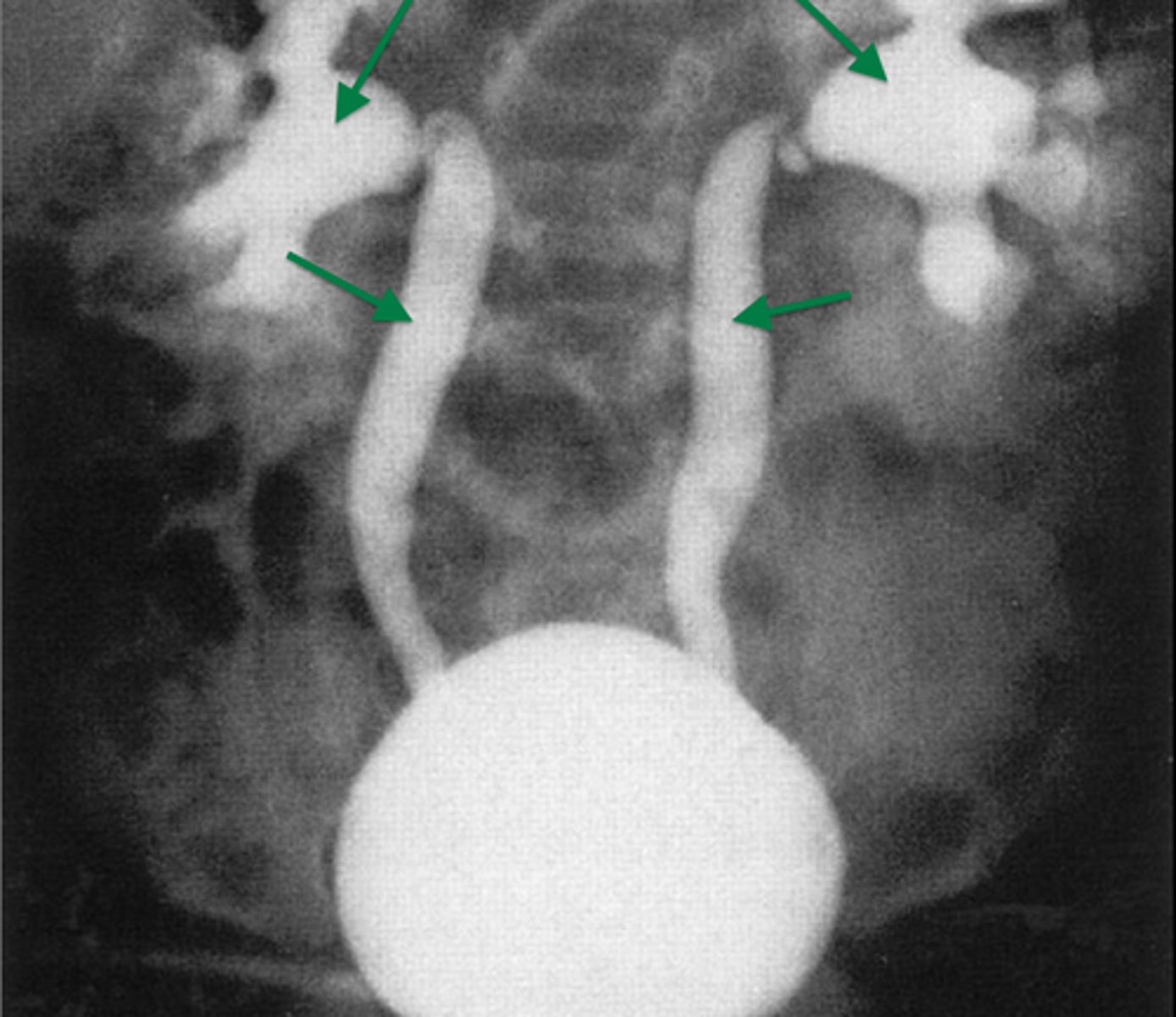 <p>Contrast via <strong><span class="bgP">cystoscopy</span></strong> to view ureters and bladder</p>