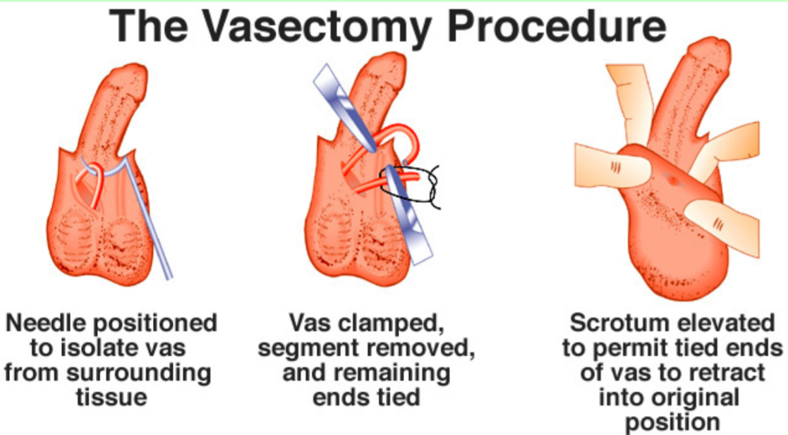 <p>The Vasectomy Procedure</p>
