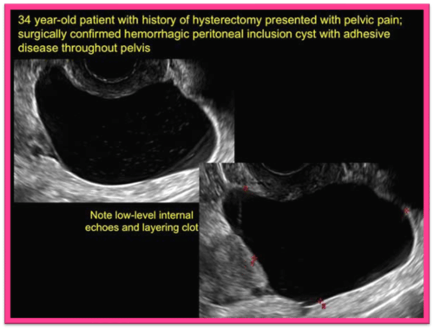 <p>adhesions; peritoneal fluid</p>
