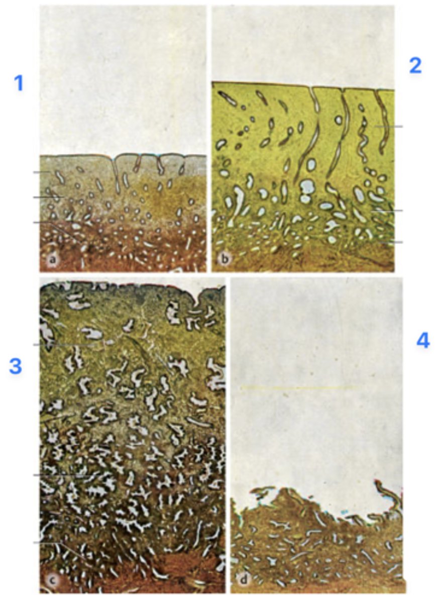 <p>A 39-year-old woman presents with infertility. She has regular menstrual periods with a 28-day cycle, and she bleeds heavily for the first 3 days. Her physician explains that she will need a thorough examination of hormonal levels and endometrial features spanning through the entire menstrual cycle. Endometrial biopsies (all micrographs with same magnification) obtained from her through the cycle are seen in the figure.</p><p>Which phase is at 3?</p>