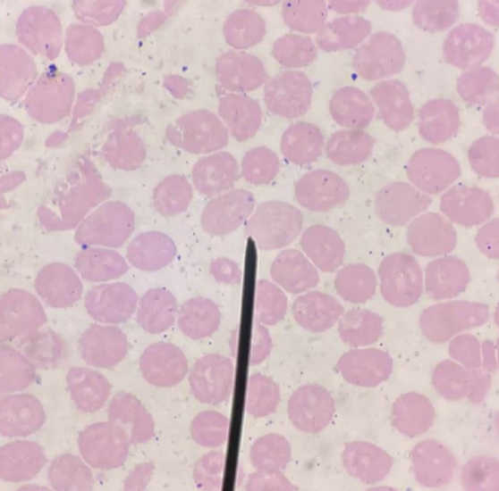 <p>A. What’s the equivalent term of reticulocytosis in a wright stained smear?</p><p>B. What is the erythropoietic activity of the bone marrow ?</p><p>C. When do you say it’s ineffective?</p><p>D. What’s the danger of death for patients with ineffective erythropoiesis?</p>