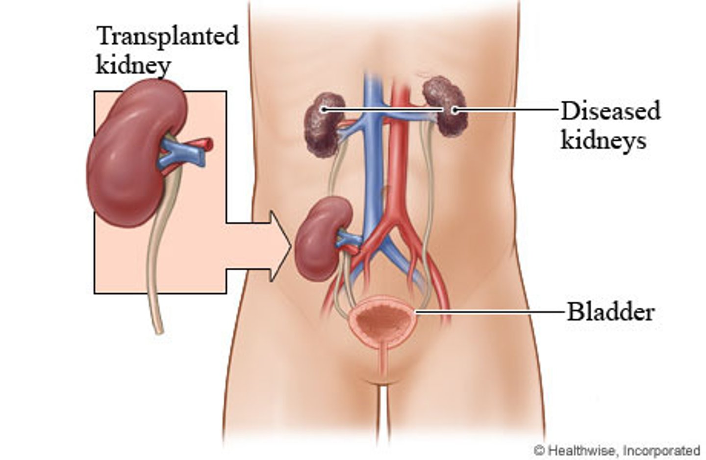 <p>the major problem with kidney transplants is tissue rejection</p><p>• now a common procedure is undertaken in patients with end-stage renal failure</p><p>• ideal place to situate the transplanted kidney is in the left or the right iliac fossa </p>