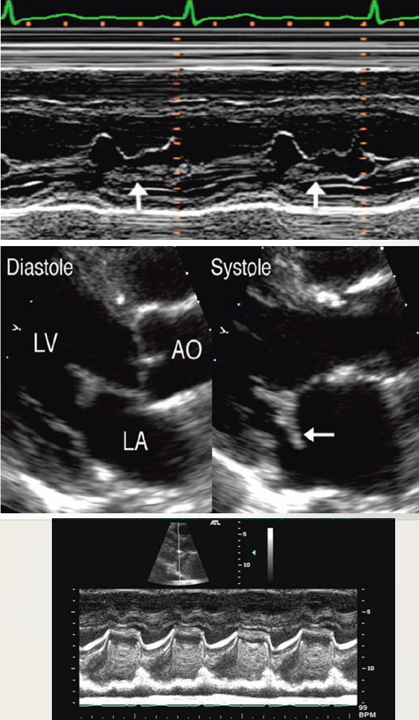 <p>shaggy</p><p>partial obliteration of interleaflet separation</p><p>abnormal opening and closure times&nbsp;</p>