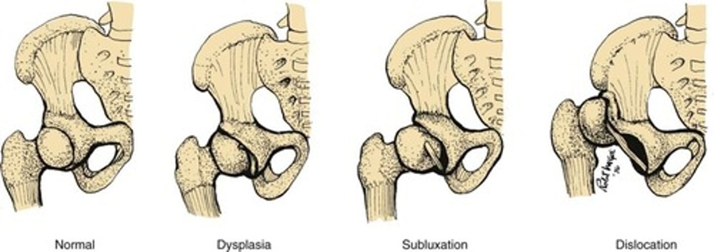 <p>abnormal development of the hip structures in infants and children</p><p>can be acetabular dysplasia, subluxation (incomplete dislocation), or dislocation (femur head not in proper position)</p>