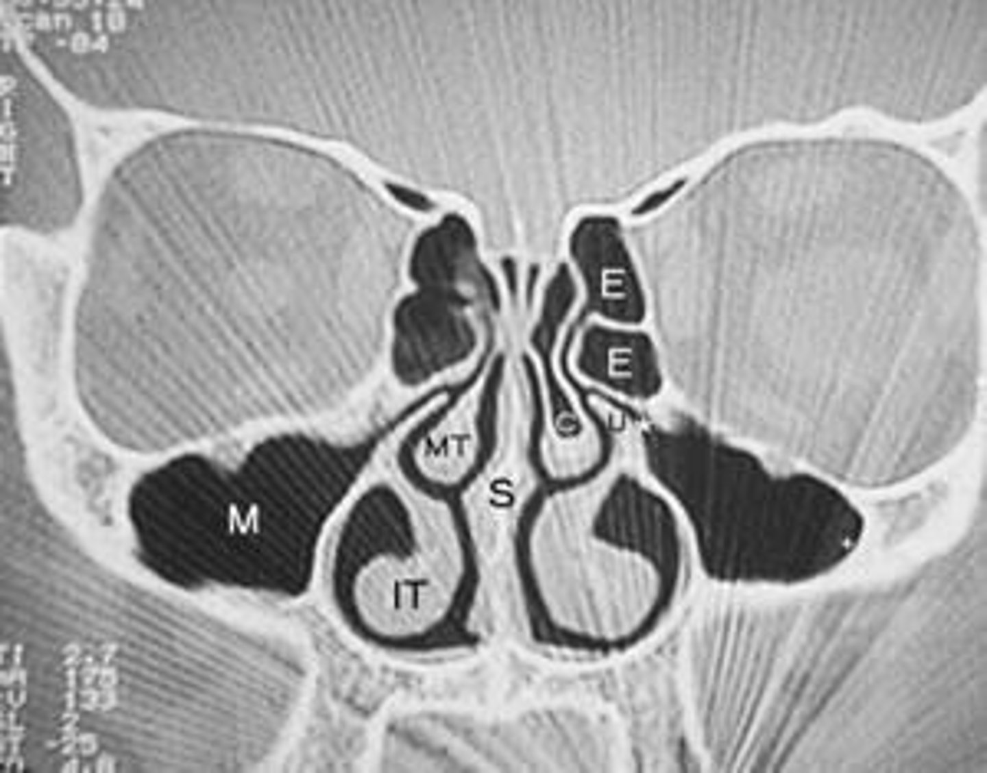 <p>Ethmoid, Maxillary, Sphenoid, and Frontal sinuses.</p>