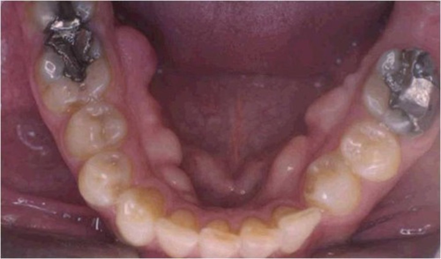 <p>Bony growths along the lingual aspect of the mandible</p>