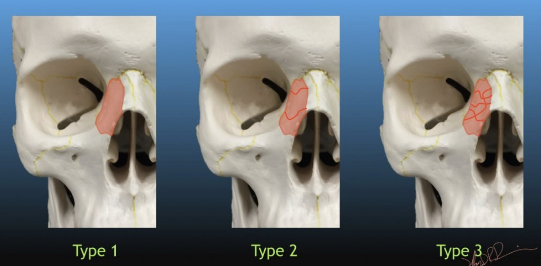 <p>Évalue l’atteinte du canthus médial</p><ul><li><p>Type I : fragment central entier </p></li><li><p>Type II : fragment comminutif </p></li><li><p>Type III : atteinte du ligament palpébral médial <span style="color: red;"><em>(exploration chirurgical)</em></span></p></li></ul><p></p>