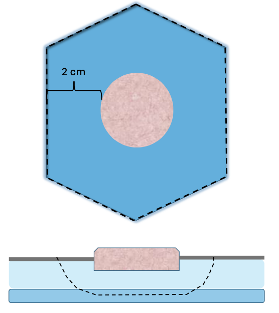 <p>MCT: 2 cm</p><p>STS: 3 cm</p><p>Deep margins - 1 fascial plane&nbsp;</p>