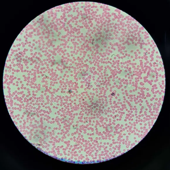 <p><span data-name="microscope" data-type="emoji">🔬</span><span data-name="petri_dish" data-type="emoji">🧫</span><strong><span> </span>Na podstawie zdjęcia preparatu:</strong></p><p></p><ul><li><p><span data-name="book" data-type="emoji">📖</span><span> </span>rozpoznaj gatunek pasożyta;</p></li></ul><p></p><ul><li><p><span data-name="recycle" data-type="emoji">♻</span><span> </span>rozpoznaj wszystkie formy rozwojowe;</p></li></ul><p></p><ul><li><p><span data-name="microbe" data-type="emoji">🦠</span><span> </span>wskaż organelle i cechy charakterystyczne dla danego gatunku;</p></li></ul><p></p><ul><li><p><span data-name="mask" data-type="emoji">😷</span><span> </span>nazwij chorobę, którą pasożyt wywołuje.</p></li></ul><p></p>