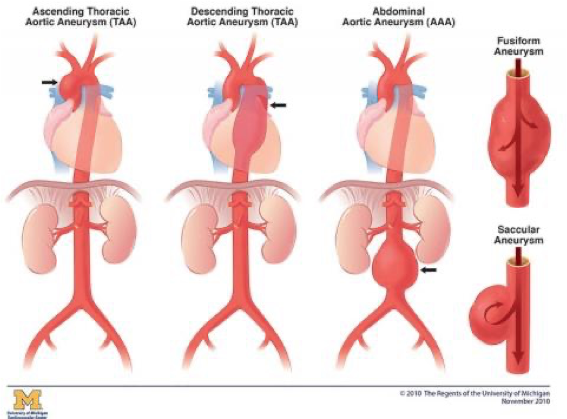 <p>Most Common types of Aortic Aneurysms</p>