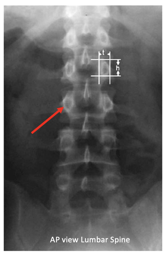 <ul><li><p>AP</p><ul><li><p>X Ray: Ant</p></li><li><p>Film: Post</p></li></ul></li></ul><p></p>
