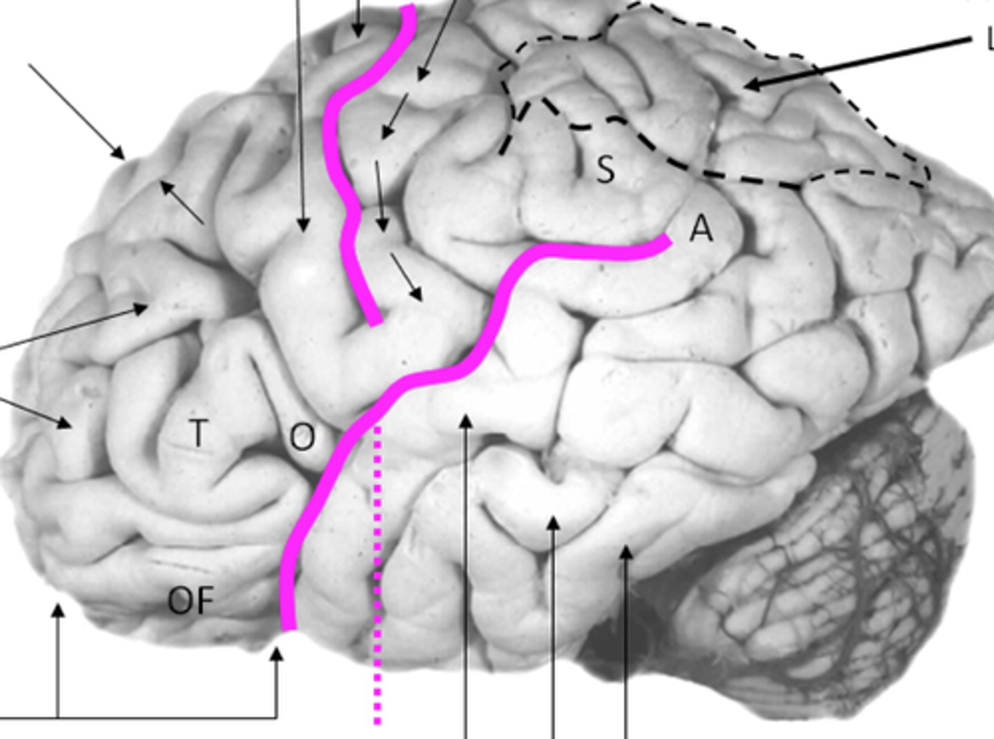 <p>- Temporal Lobe</p><p>- Visual Identification of familiar objects</p><p>- EX. Becomes active when we are looking at faces</p><p>- A lesion here could cause a person to treat familiar people as unfamiliar people</p>