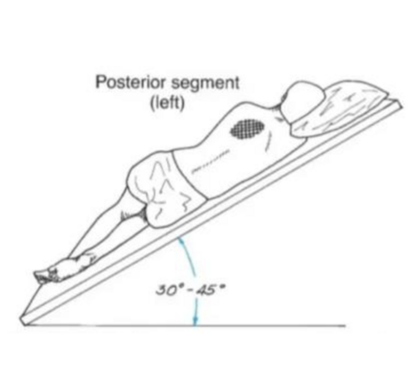 <p>patient lies one-quarter turn from prone and rests on the right side; head and shoulders are elevated 45 degrees or approximately 18 inches if pillows are used; percussion is applied directly over the left scapula</p>
