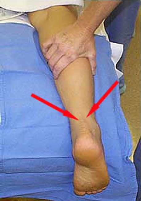 <ul><li><p><strong>Torn achilles tendon</strong></p></li><li><p>squeeze calf </p></li><li><p>positive = no motion</p></li></ul><p></p>