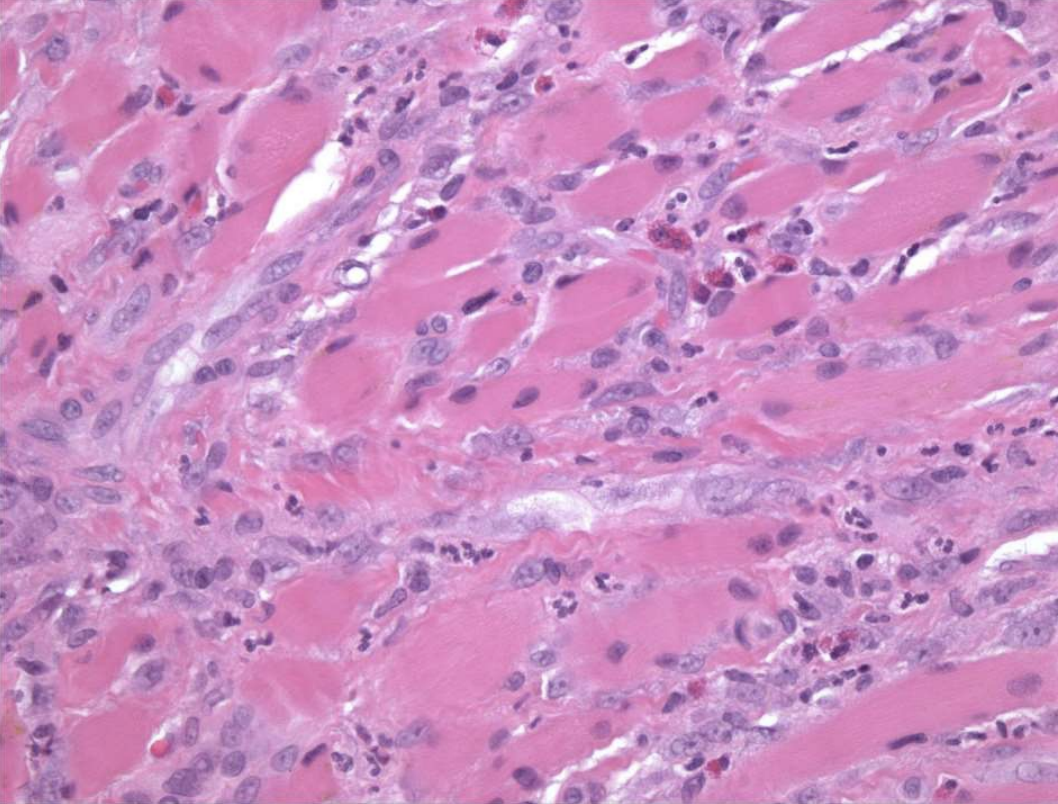 <ul><li><p>numerous eosinophils</p><ul><li><p>may be called Traumatic Ulcerative Granuloma with stroma eosinophilia (TUGSE)</p></li></ul></li><li><p>inflammation of skeletal muscle</p></li><li><p>granulation tissue</p></li></ul><img src="https://knowt-user-attachments.s3.amazonaws.com/b521a99d-d3ff-49b6-986f-eb07aadacc4a.png" data-width="100%" data-align="center"><p></p>