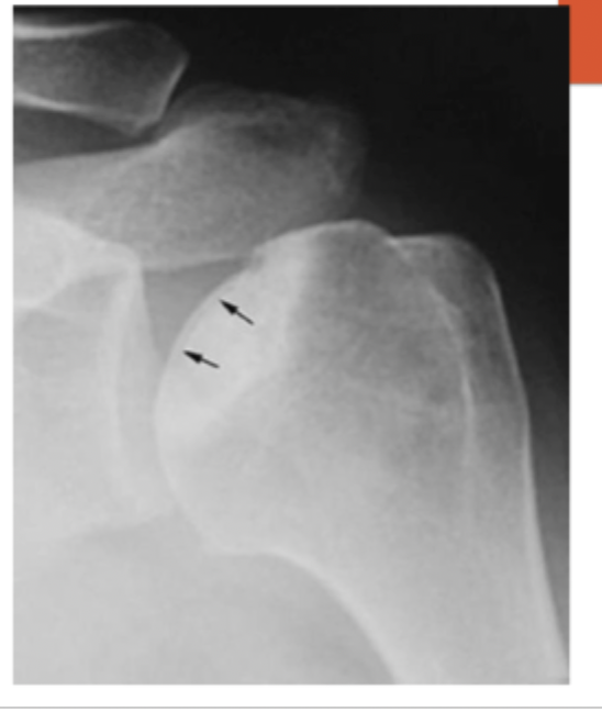 <p>xrays show signs of collapse “crescent signs”</p>