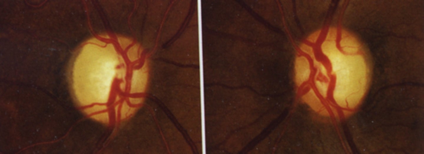 <p>neoplasm in cranium (craniopharyngioma) causing compression</p>