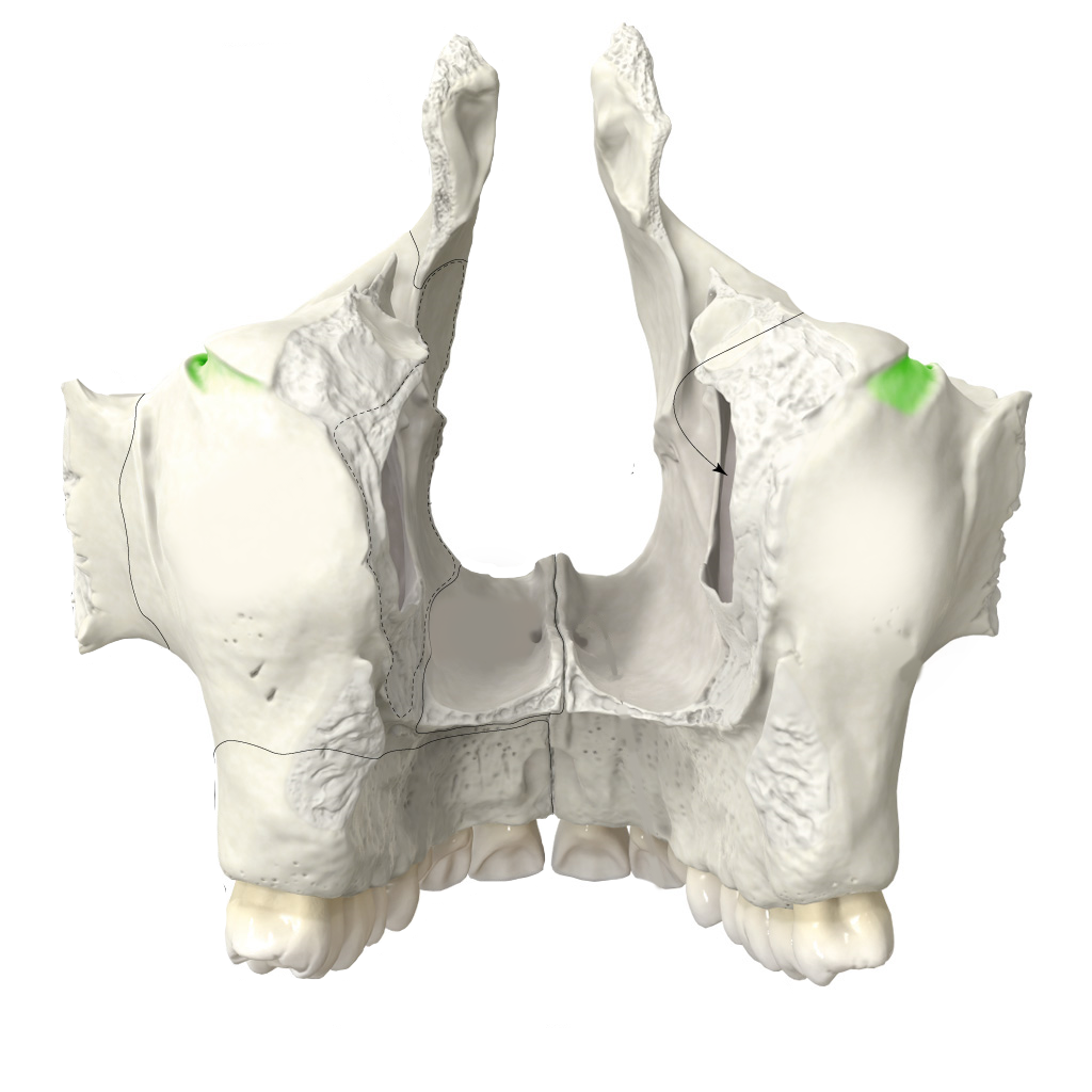 <p>infraorbitalis csatorna bevágása (canalis infraorbitalis kezdete)</p>