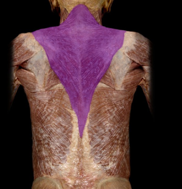 <p>superficial, upper back, makes upside-down triangle; origin is occipital bone + vertebrae and inserts on scapula and clavicle</p>
