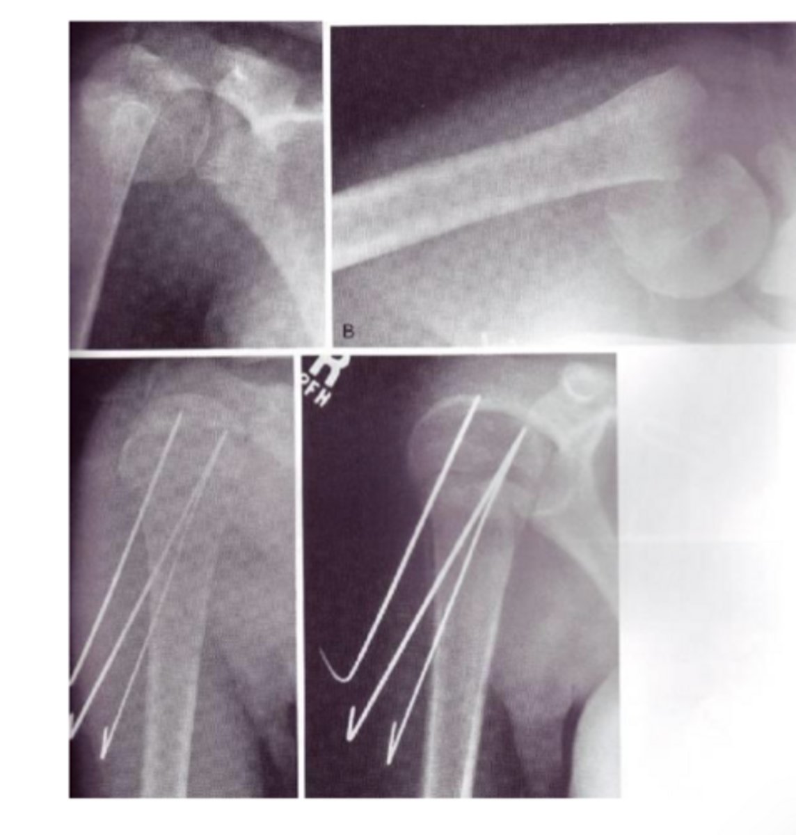<p>running small pins across the fx</p>
