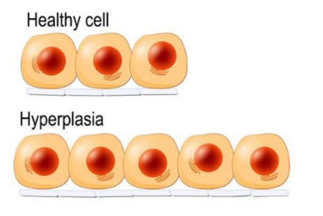 <p><strong>Hyperplasia</strong></p>