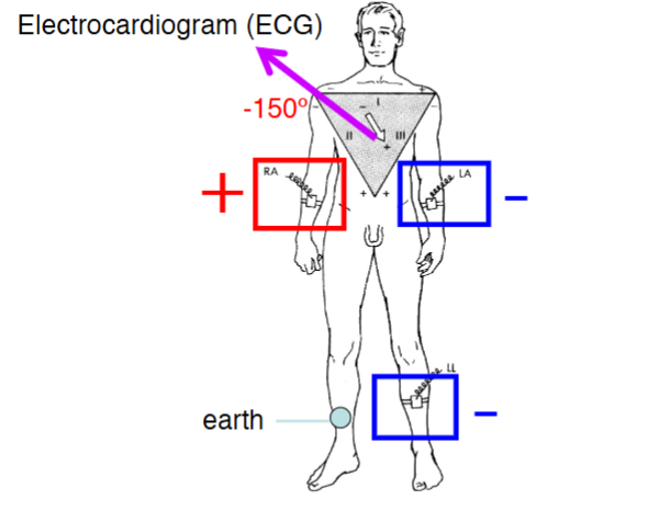 <p>2 negative electrodes (RA &amp; LA) and 1 positive electrode are placed on the person’s 2 arms and left leg. By swapping the position of the positive electrode, the direction of the ECG vector changes to go between:</p><p>+ 90<span>º with + on leg (aVF - augmented voltage left foot)</span></p><p>- 30º with + on left arm (aVL - augmented voltage left arm)</p><p>- 150º with + on right arm (aVR - augmented voltage right arm)</p>