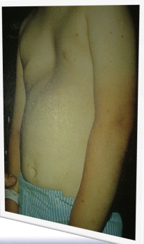 <p>Pectus excavatum</p>