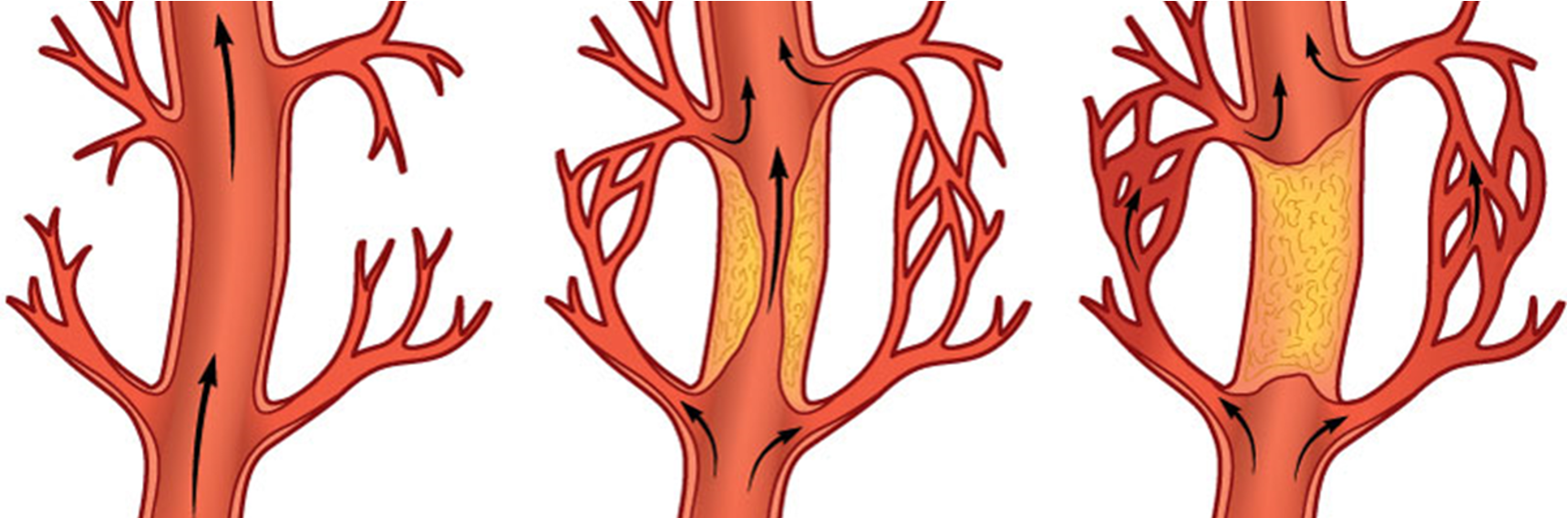<p>A network of small blood vessels that develop in response to a blockage or narrowing (stenosis) of a larger artery or vein</p><p>These vessels provide an alternative pathway for blood to flow, bypassing the obstruction and delivering oxygen and nutrients to the affected tissues</p>