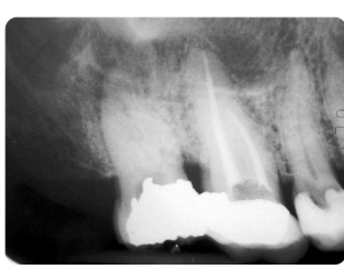 <p>La Periodontitis Periapical Aguda causar respuestas espontáneas de carácter moderado o intenso de dolor al morder, a la percusión o respuesta a las temperaturas.</p><p>Si la PPA representa la extensión de una pulpitis, se observa también:</p><ul><li><p>Respuesta al frío y calor.</p></li><li><p>Al presionar con la punta del dedo o golpear con el mango del espejo (percusión) se puede provocar un dolor intenso o insoportable</p></li><li><p>El diente puede sentirse extruido y el paciente tener dolor al ocluir y masticar</p></li></ul><p>Cuando la PPA se debe a la necrosis pulpar: no responde a las pruebas de vitalidad.</p>