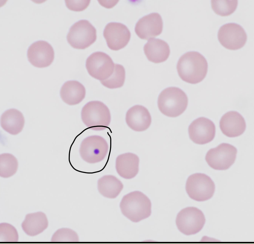 <p>What RBC inclusion is depicted in this image?</p>