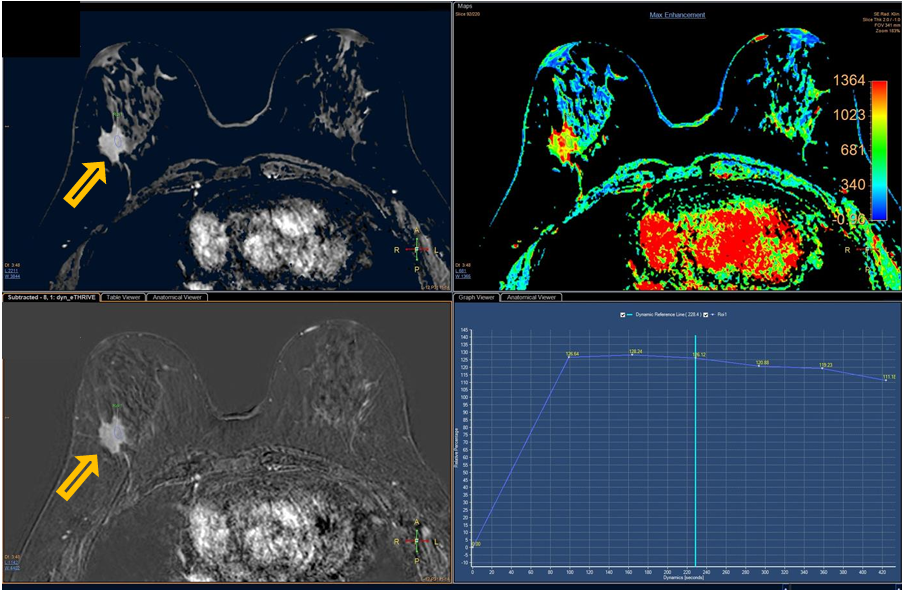<p>Patient history: known invasive ductal carcinoma, staging MR </p><p>Modality: dynamic contrast enhanced MRI (eThrive – upper left image), dynamic subtraction MRI (lower left image); contrast agent: iv. gadolinium; right images show the kinetics of contrast enhancement (highest rate of washout signed with red color) Region: breast, axial plane </p><p>Radiologic sign: Irregular, spiculated mass in the right breast (yellow arrow), with intense contrast enhancement. The kinetic enhancement curve is characterized by a washout pattern. </p><p>Diagnosis : invasive breast carcinoma in the right breast, no multiplicity or contralateral breast lesion</p>
