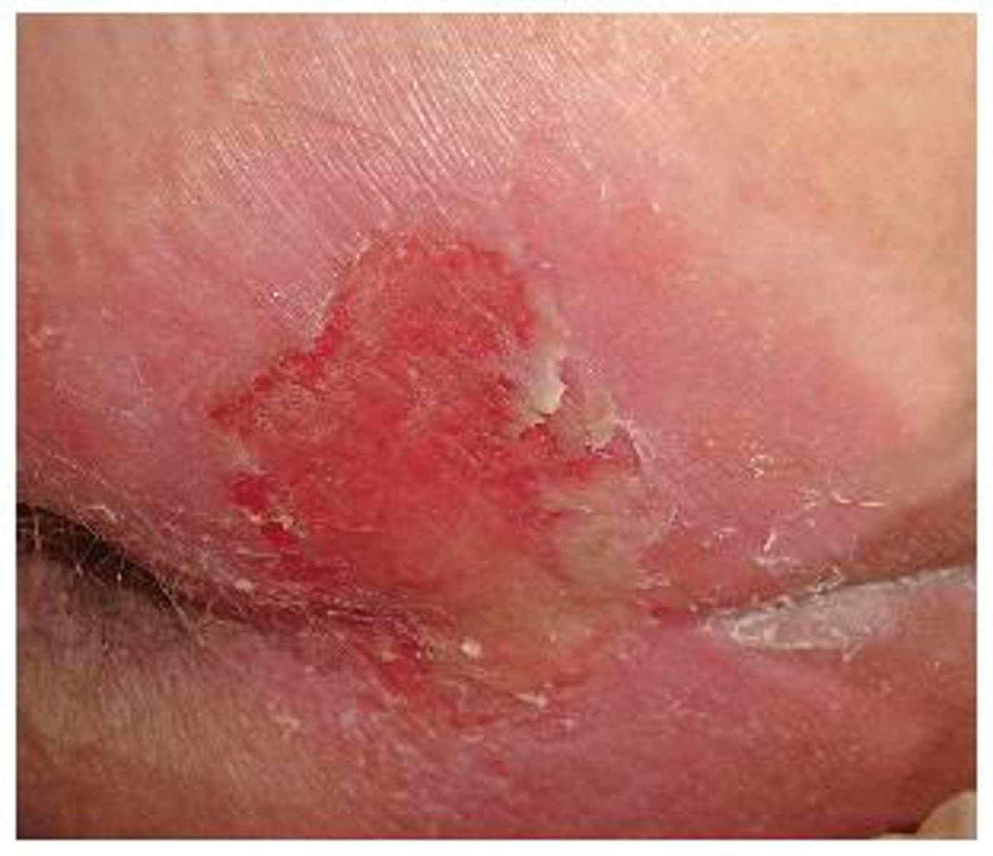 <p>i) Partial thickness skin loss with exposed dermis</p><p>ii) Blister</p><p>iii) Wound bed pink, red, moist</p>