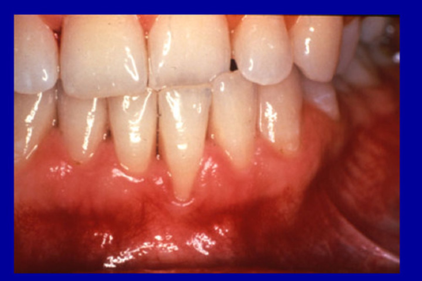 <p>areas with no attached gingiva present, the PPD will present below the mucogingival junction (worse than defect)</p>