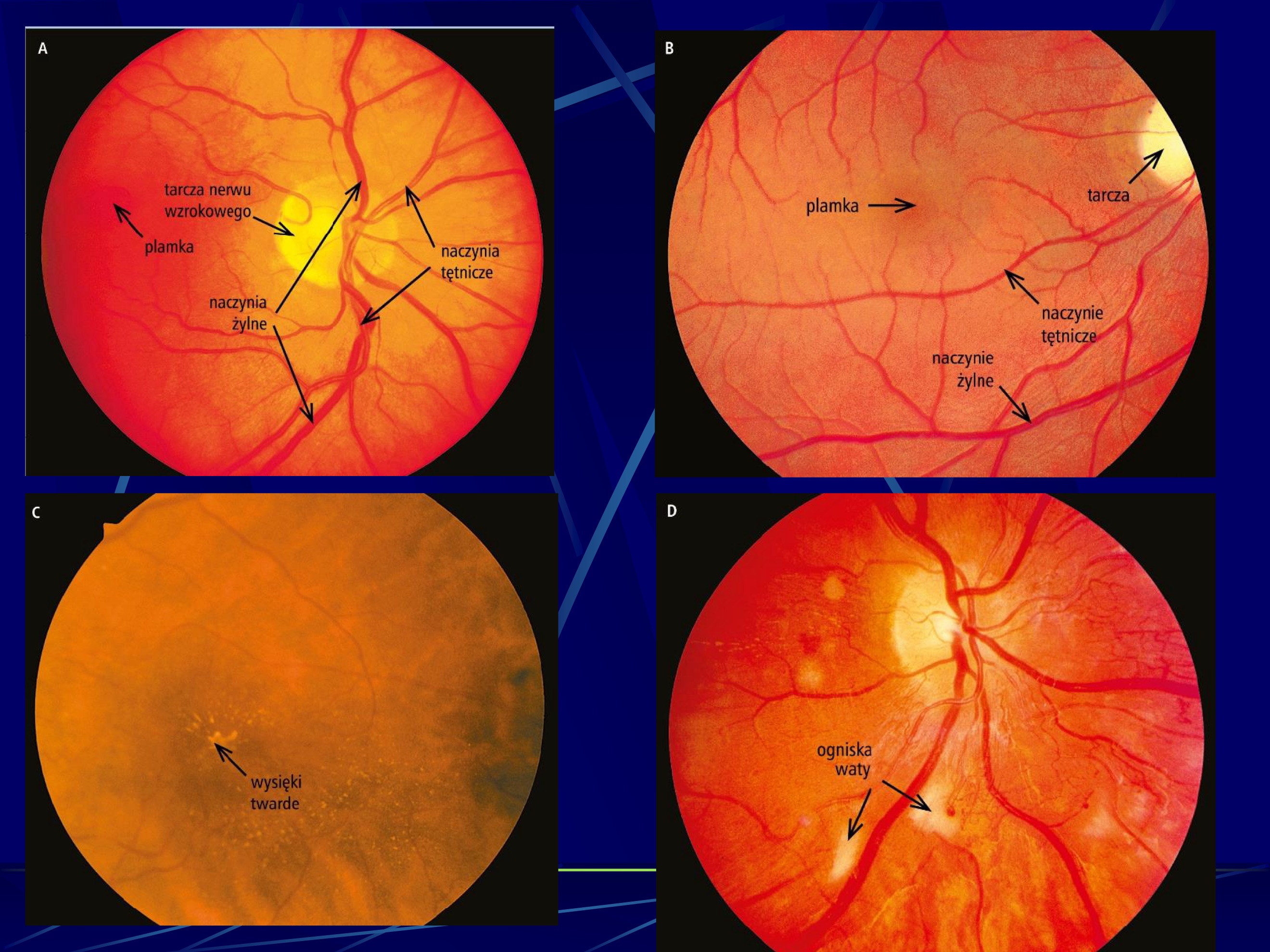 <p>Klasyfikacja zmian w siatkówce wg.</p><p>Keitha i Wegenera</p><p>Stopień I – Zmiany minimalne bez ognisk</p><p>krwotocznych</p><p>Stopień II - Stwardnienie tętniczek +/-</p><p>ogniska krwotoczne</p><p>Stopień III – Wysięki +/- ogniska</p><p>krwotoczne</p><p>Stopień IV - Obrzęk tarczy nerwu</p><p>wzrokowego</p>