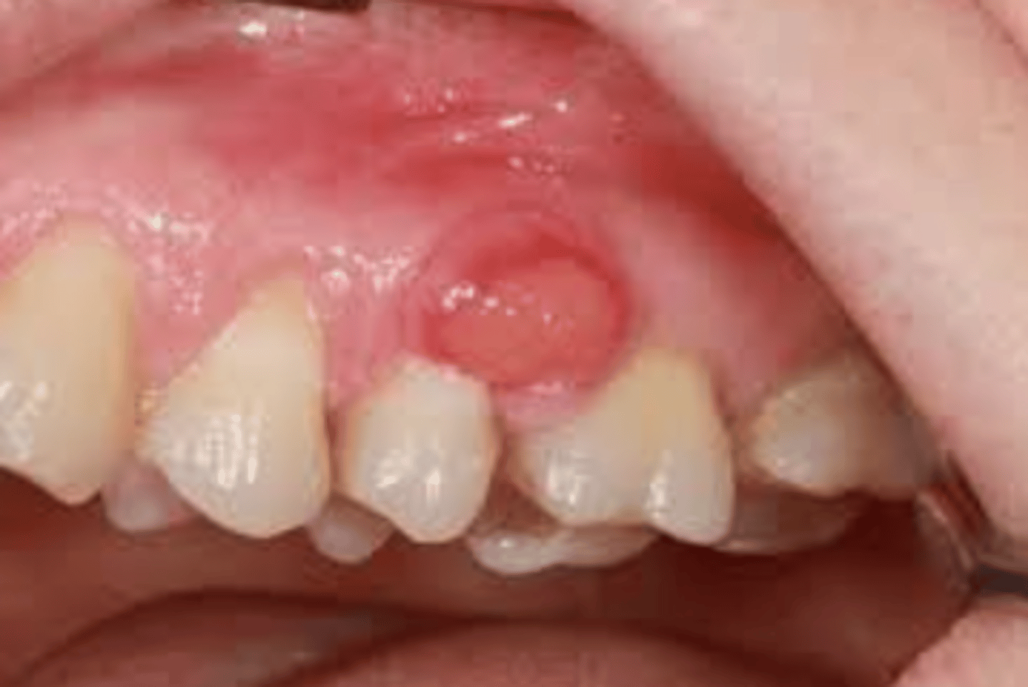 <p>Inititalt gulaktiga, eller hemorragiska blåsor och läker med ärr</p>