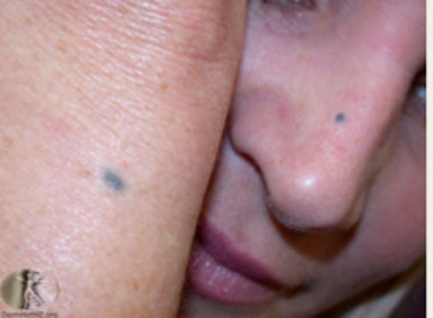 <p>which type of pigmented lesion:</p><p>• Uncommon</p><p>• Benign proliferation of</p><p>melanocytes deep in the</p><p>connective tissue</p><p>• Children/YA</p><p>• Blue in color→ Tyndall Effect</p><p>• Usually found on the palate</p>