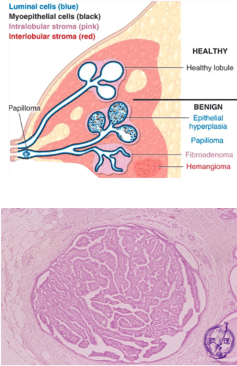 <p>Define Condition:</p><p>Papillary growth of ductal epithelial cells, usually into a large duct</p><p>-Hx: Premenopausal Women</p><p>-Sx/PE: bloody nipple discharge</p><p>-Dx: fibrovascular projections (papillae) lined by both epithelial (luminal) and MYOEPITHELIAL CELLS (diff from Papillary Carcinoma)</p>