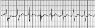 <p>What type of arrhythmia is this? </p>