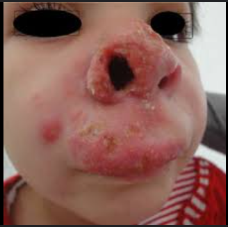 <p>Oral/nasal destruction, ulcers, swelling.</p>