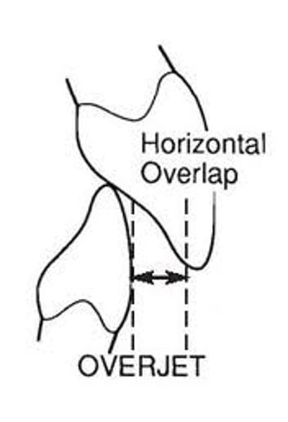 <p>- horizontal overlap<br>- projection of teeth beyond their antagonists in the horizontal plane</p>