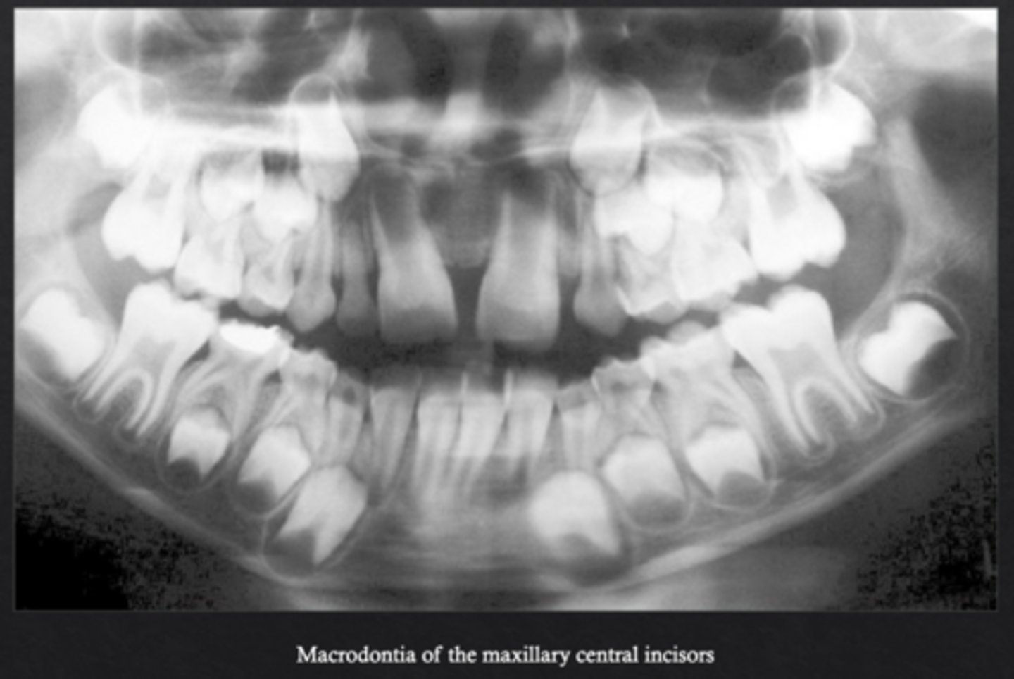 <p>Teeth are larger than normal *may be syndrome associated</p>