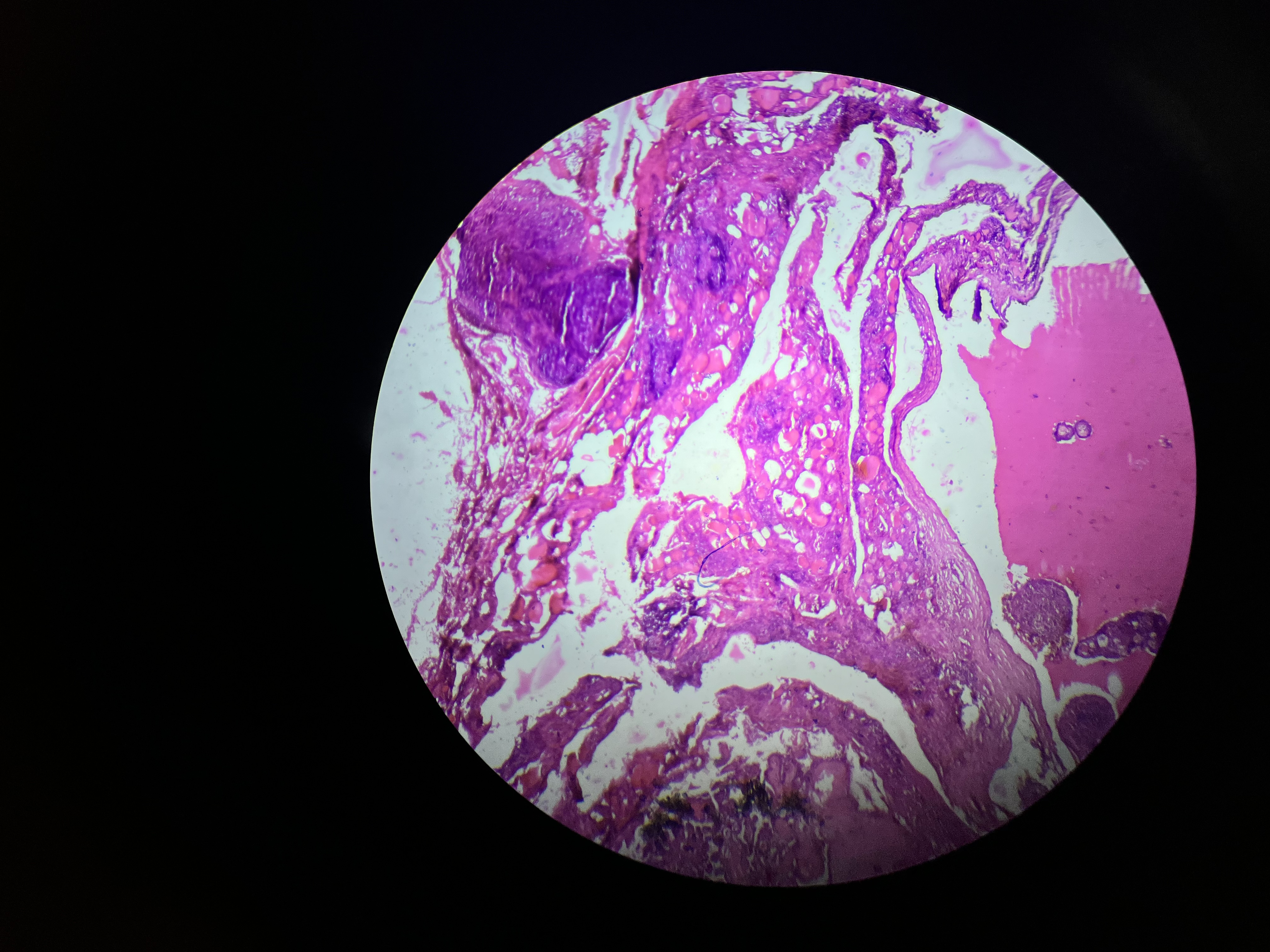 <p></p><ul><li><p>The most common type of thyroid cancer, characterized by follicular cell origin and often presenting as a slow-growing mass. </p></li></ul><ul><li><p>It typically has a good prognosis and may exhibit features such as psammoma bodies and nuclear atypia. </p></li></ul><p></p>
