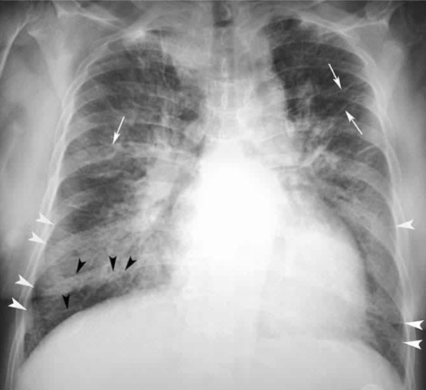 <p>CXR indicated for Dx and progression. Shows progressive changes from normal to pulmonary edema</p>