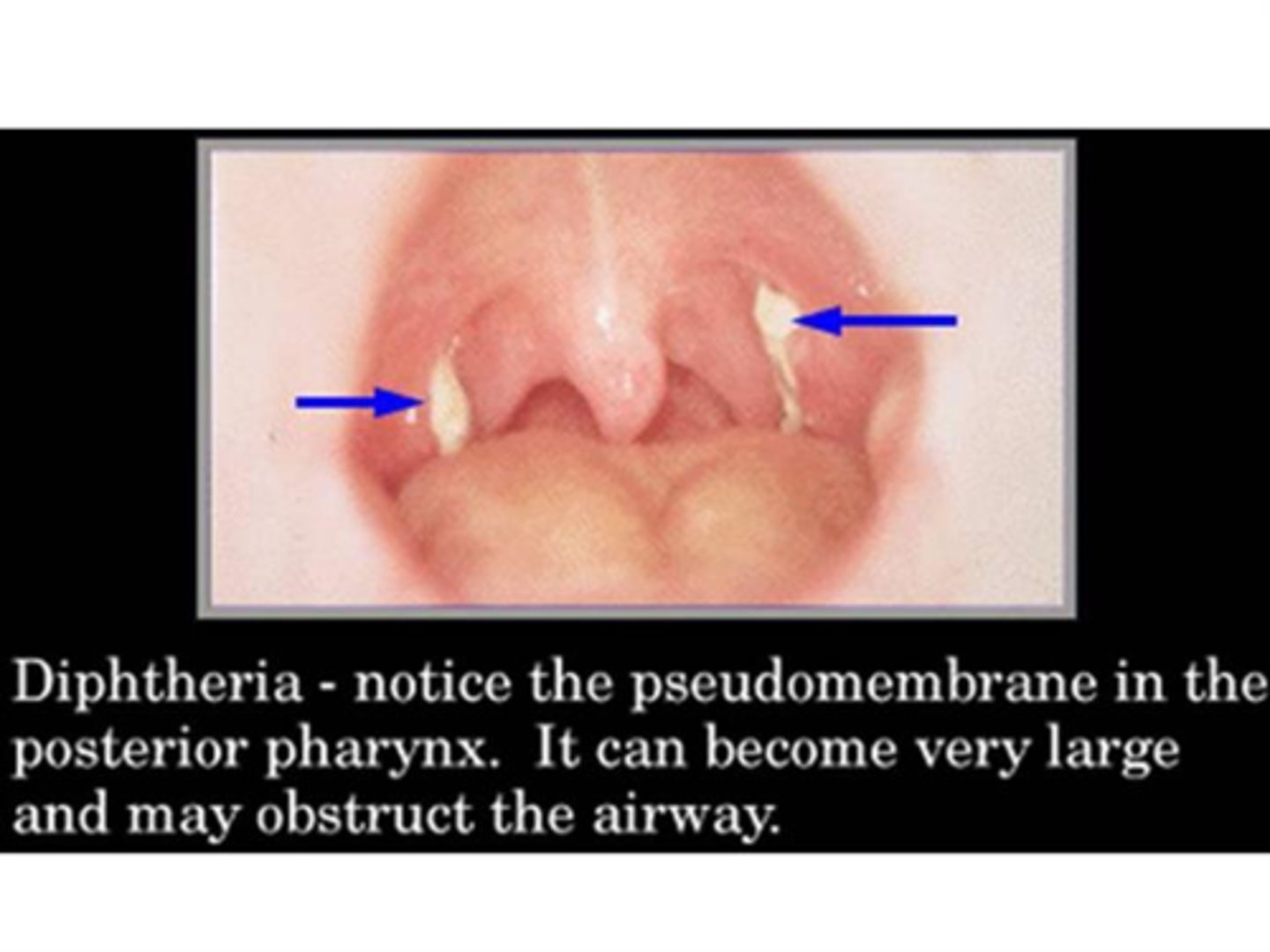 <p>Diphtheriae is characterized by pseudomembrane formed by dead cells and exudate at the back of the throat</p>