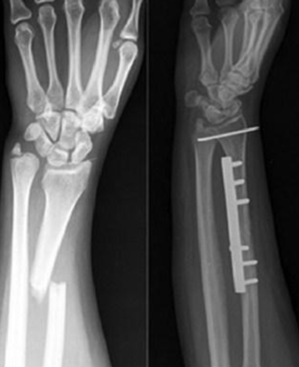 <p>Dislocation: distal radio-ulnar</p><p>Fracture: radius</p><p>Fall on hand with rotational force</p><p>Ex: bruising, swelling and tenderness lower end of forearm</p><p>XR: displaced radius # with prominent ulnar head</p><p>(due to dislocation of the inferior radio-ulnar joint)</p>