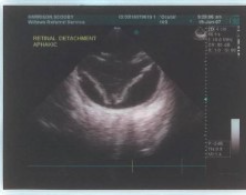 <p>What problem can be identified in this ocular ultrasound</p>