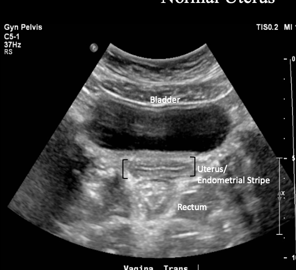 <p>Normal Uterus Transabdominal </p>